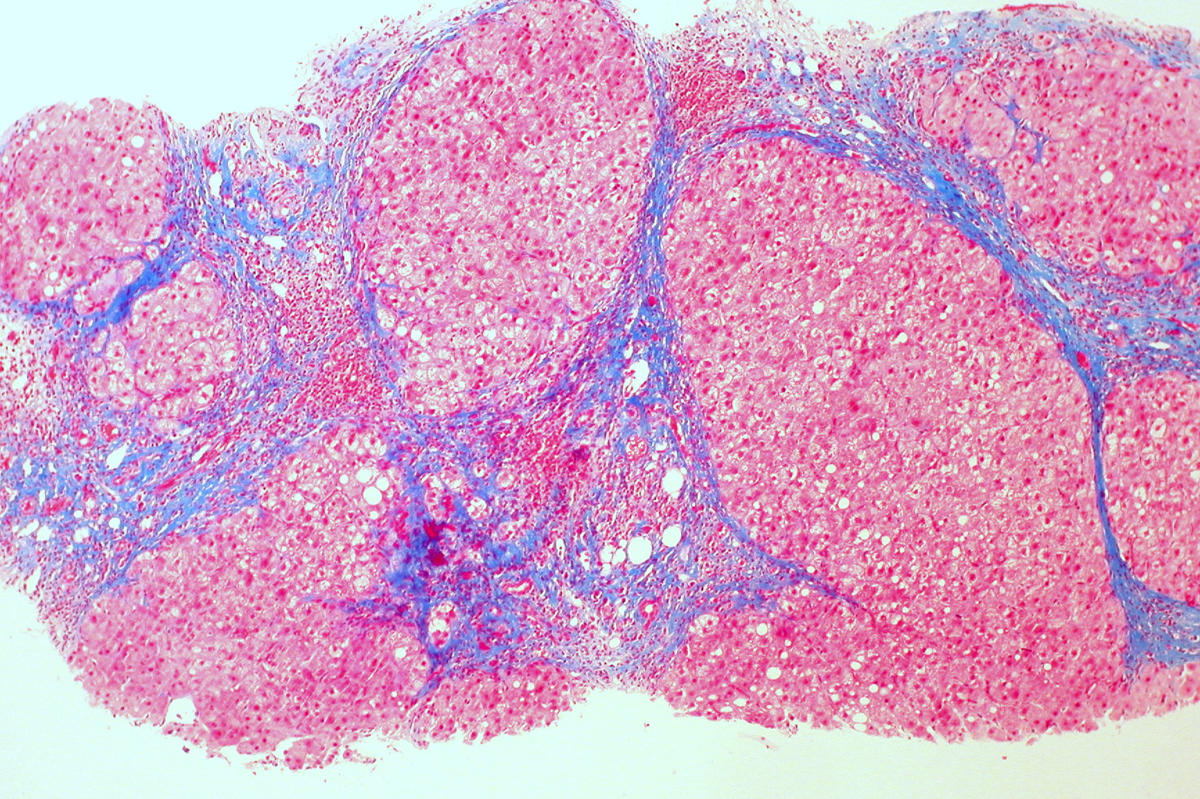 Trichrome stained liver micrograph showing cirrhosis with fibrous bands.